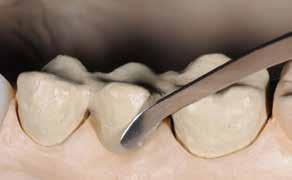Dentin/incisal layering The layering procedure of the individual SR Nexco Paste materials is carried out either in accordance with the layering diagram