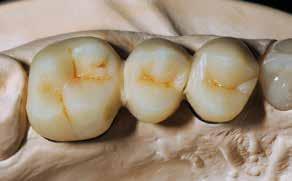 Margin material may be applied in a half-moon shape to cervical areas, pontics and crown margins that are thinning towards the metal.