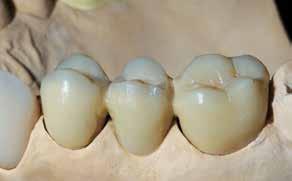 The shade effect in the interdental area may be enhanced by means of chromatic materials, such as Occlusal Dentin orange.