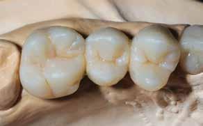Make sure to provide adequate space for the subsequent application of the Incisal and Transpa materials.