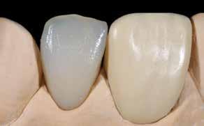 adjust the shape and shade. Cover with Incisal material.