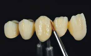 Individualization and pressing the incisal area Individualization If desired, the restoration can be individualized using SR Nexco Stains and Effect materials.