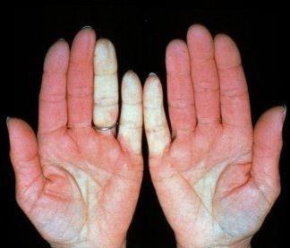 Cold intolerance Raynaud s phenomenon Vasoconstriction helps maintain core temperature RP is exaggerated