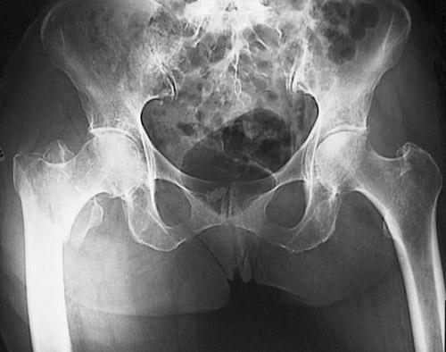 HIP FRACTURE >20% fatality 50% permanent disability or