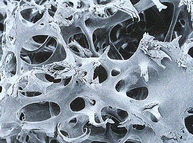 Normal Osteoporosis Osteoporosis is not just a