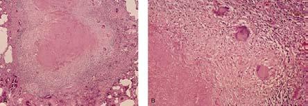 Caseous granulomas Giant cells Inert