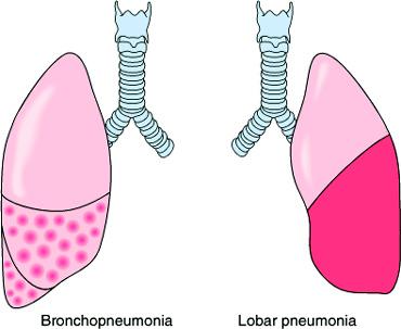 Pulmonary Infections Bacterial Pneumonia