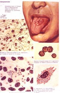 changed things a lot Histoplasmosis Dimorphic yeast Fungal growth phase Oral or pulmonary