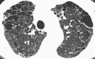 USMLE TEST A 60-year-old male presents to your office complaining of dyspnea on exertion. He reports smoking two packs of cigarettes per day for the past 25 years. A lung CT is shown in Figure A.