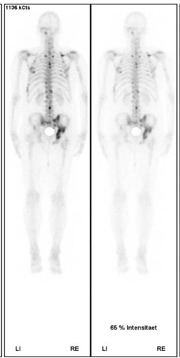 CRPC first-line 76 y old patient Rising PSA on ADT Testosterone (<0.35nmol/l) Bone scintigraphy : Multiple bone metastases PSA 85 41 15 22 01.01.20 01.02.20 01.03.20 01.04.