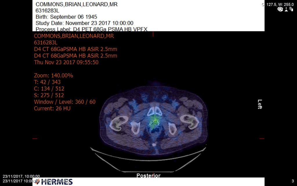The PSMA PET CT scan indicates avidity with in the right anterior prostate