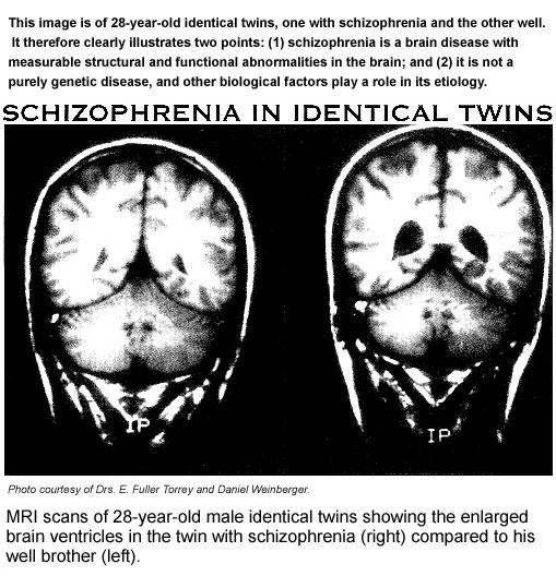 medications are discontinued. Can Children Have Schizophrenia? Children over the age of five can develop schizophrenia; however, it is very rare before adolescence.
