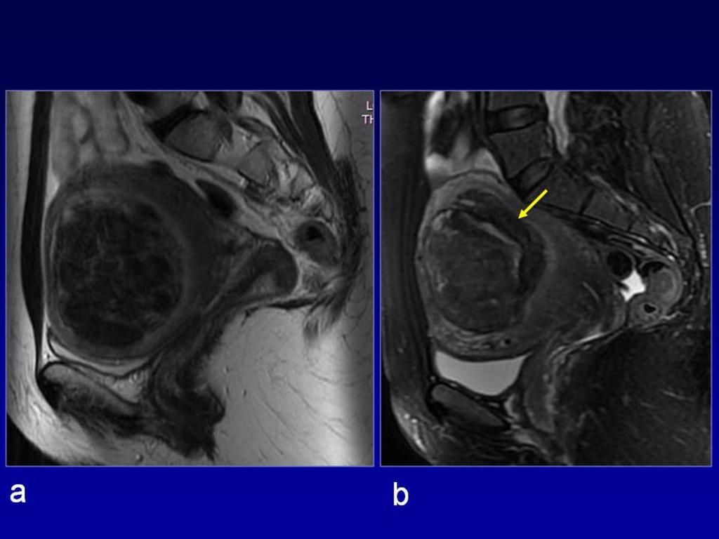 Fig. 2: a: Pretreatment MRI. Fast T2-weighted (FSE) image in the sagittal plane, shows a large, well circumscribed fibroid with inhomogeneous low signal intensity. b: Posttreatment MRI.