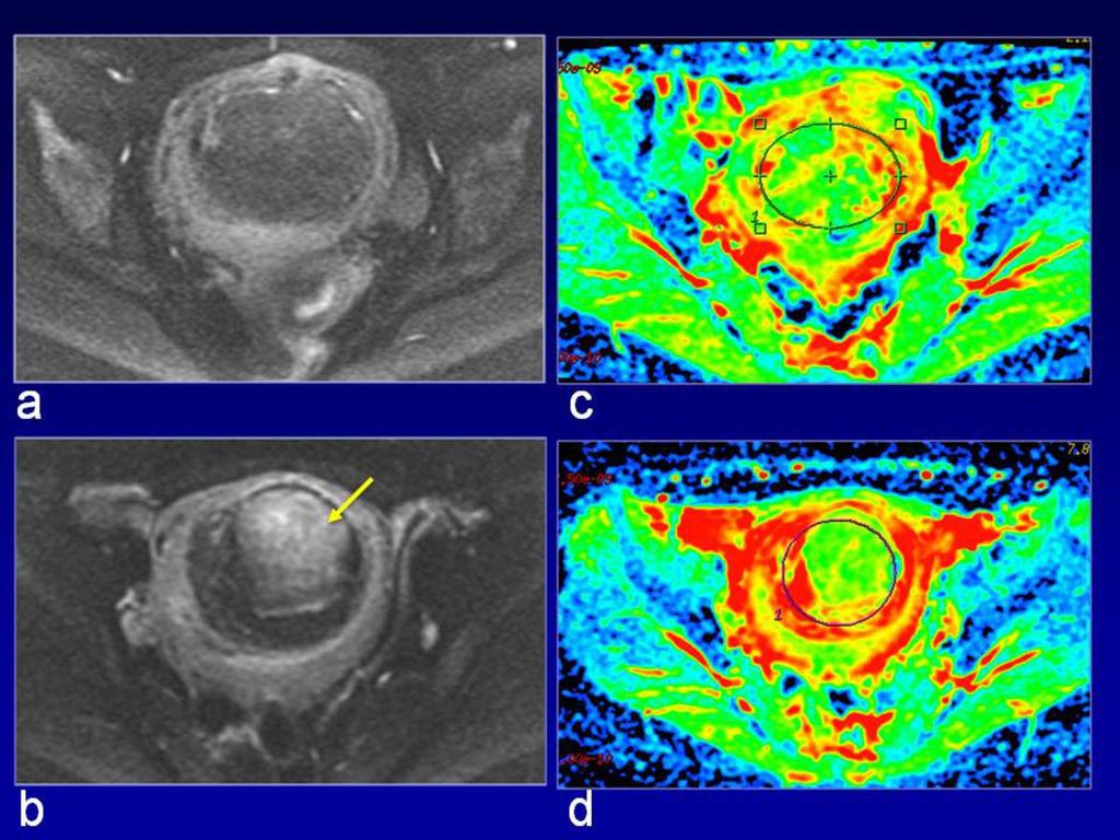 Fig. 3: Pre-treatment and post-treatment axial DWI images and ADC maps.