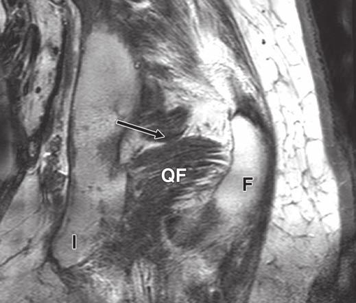 MRI of the Quadratus Femoris Fig. 5 Cadaver of 69-year-old man with normal anatomy of quadratus femoris muscle.