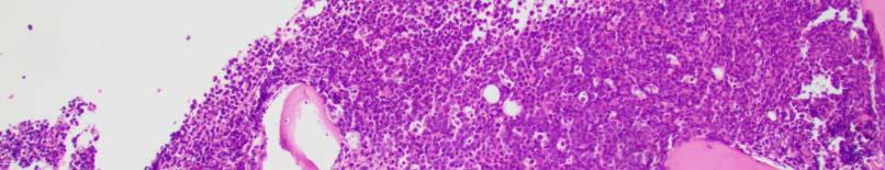Diagnosis Bone marrow biopsy: Acute myeloid