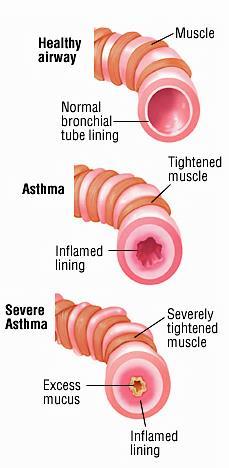 Why is asthma important? Asthma is the most common chronic disease of childhood.