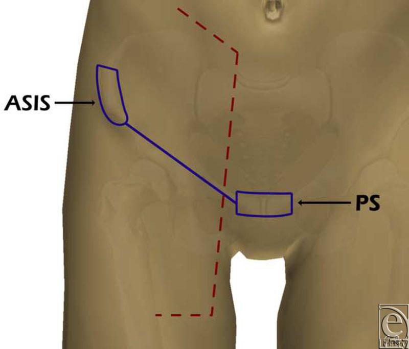 eplasty VOLUME 10 Figure 2. Skin benchmarks and dissection markings. ASIS indicates anterosuperior iliac spine; PS, pubic symphysis.