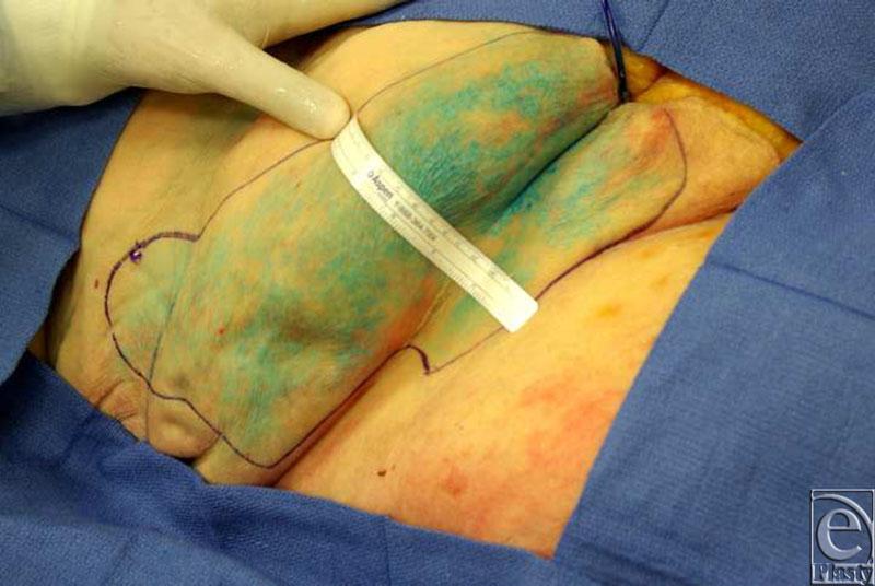eplasty VOLUME 10 Figure 5. The maximum skin area (375 cm 2 ) staining obtained after selective injection. Table 1.