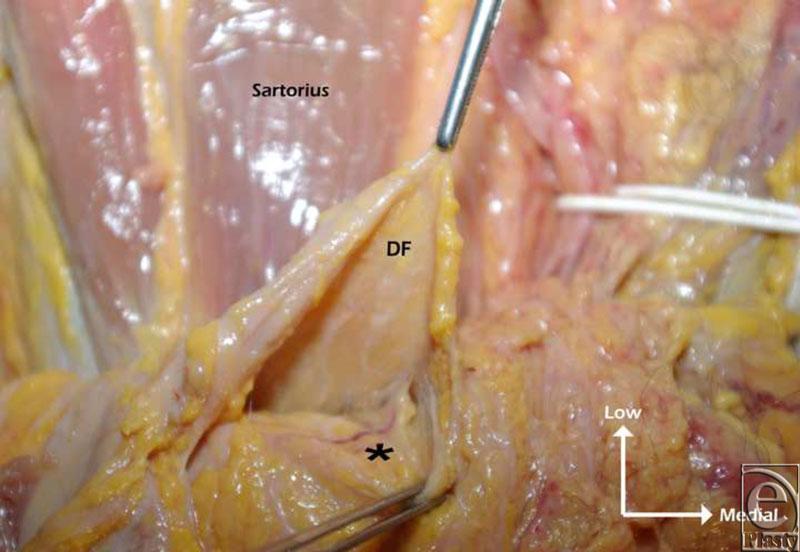(a) The deep fascia was raised to demonstrate the perforator through Sartorius muscle. (b) View of the perforators above the deep fascia.