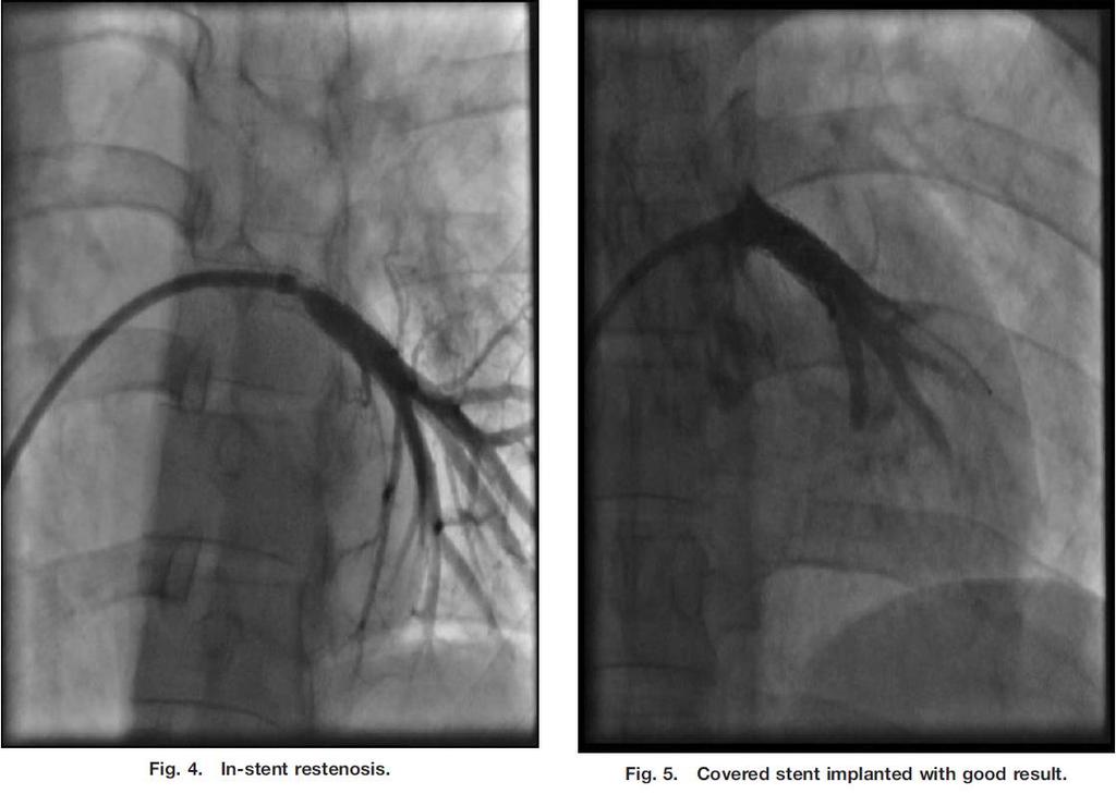 Stent implantation-covered