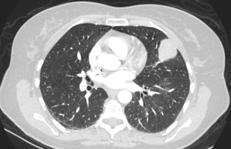 5 Distant metastasis old school thinking of SUV of pulmonary nodules > 2.5 malignant < 2.
