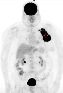 diagnosis High affinity to all types of esophageal CA False negatives are due to small size of tumor Caveat: distal esophageal
