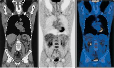 The PET/CT scan Evaluating therapeutic response SUV FDG PET for evaluating treatment Standard Uptake Value measurements depend on several factors: standardizes uptake from