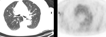 positive axillary LN False negative LN Smaller (< 5 mm) Fewer LN present PET/CT best when LN are numerous 72 y/o female diagnosed one month prior No treatment yet Large breast mass with