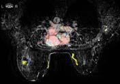 year later Extensive mets Liver Bone Brain Nodes same patient 18 months later Resolution of