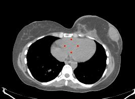 5 all lung CA FDG avid Size of the nodule determines detection, regardless of the histologic type > 1cm - PET