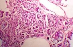 1: Microscopic appearance of Pleomorphic adenoma showing both epithelial and mesenchymal components Fig.