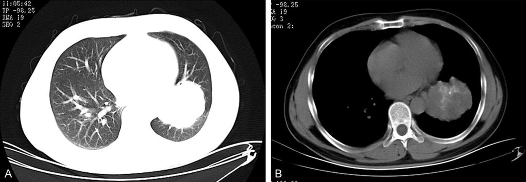 Figure 1. CT findings revealed a solid mass with calcification measuring 65 mm 78 mm in the left lower lobe (A and B). Figure 2.