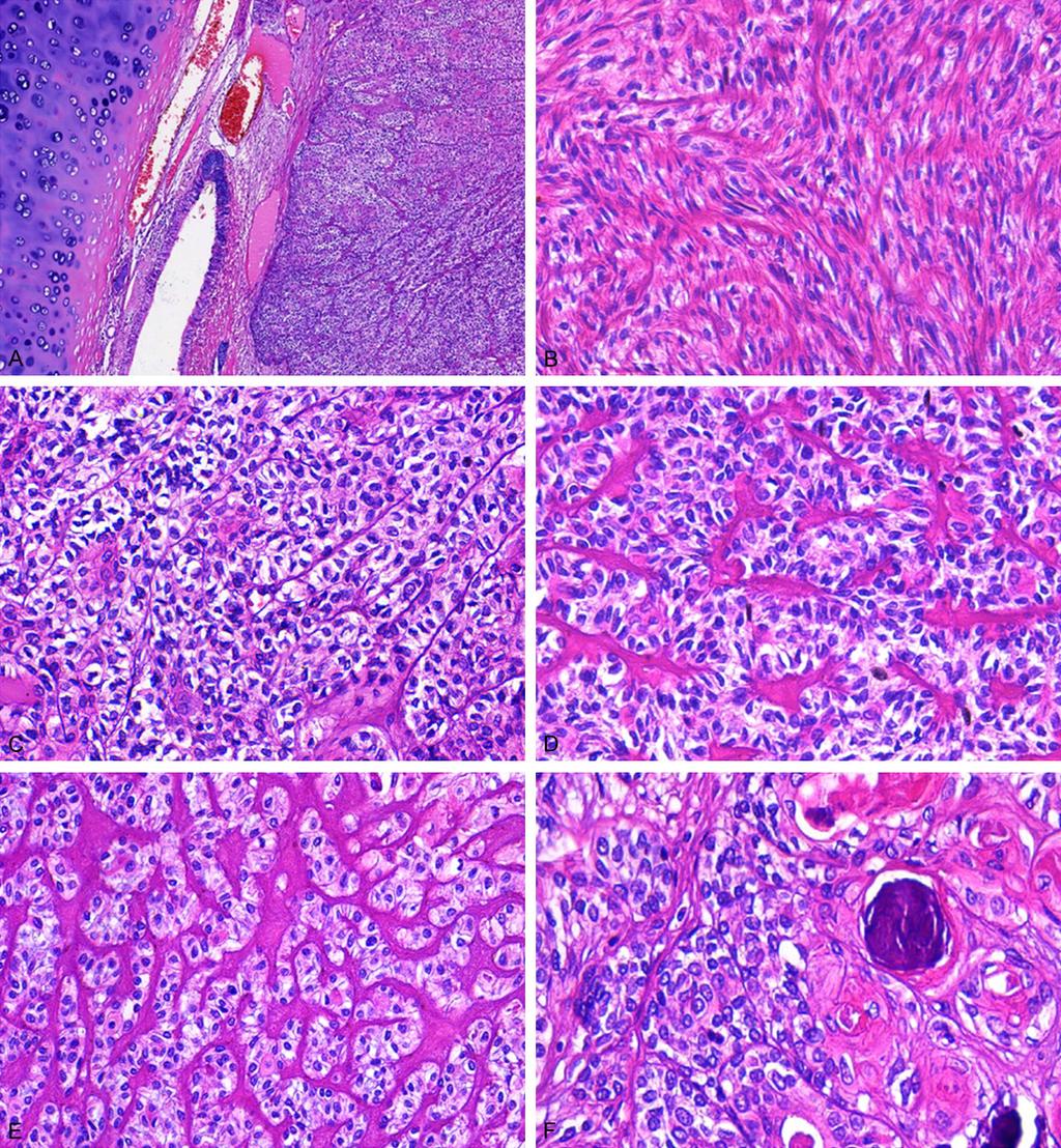 Primary myoepithelial carcinoma of the lung Figure 3.