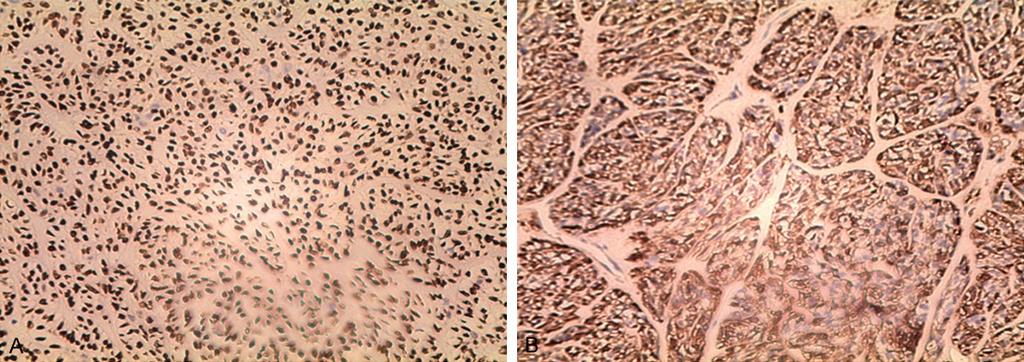 Figure 4. Immunohistochemically, neoplastic cells were strongly reactive for p63 (A; EnVision, 50 ) and S-100 (B; EnVision, 50 ).