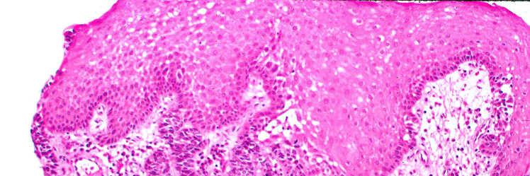 Adenoid Cystic Carcinoma Sharply defined cell nests close to surface mucosa Basaloid cells Hyperchromatic to