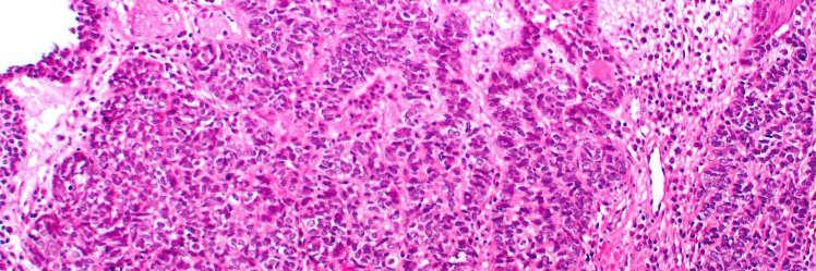 , often CIS Comedonecrosis Stromal hyalinosis BSCC Adenoid Cystic Hyaline cylinders Common Common Cribriform pattern