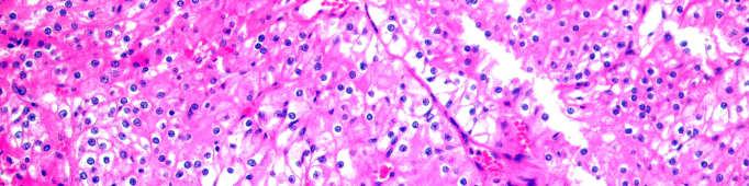 Clear Cell Oncocytoma Clear Cell