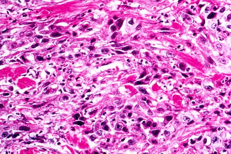 Necrotizing Sialometaplasia v. Mucoepidermoid Carcinoma Lesions Mimicking Mucoepidermoid Carcinoma Nec.