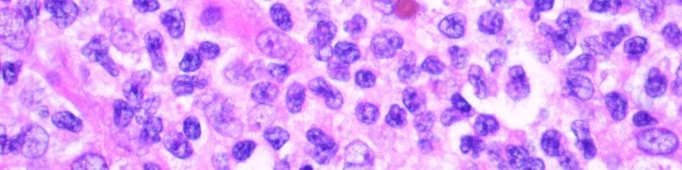 lymphoma or undifferentiated