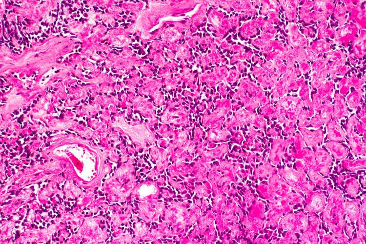 Adenoid Cystic Carcinoma Mixed Tumor Adenoid Cystic Hyaline
