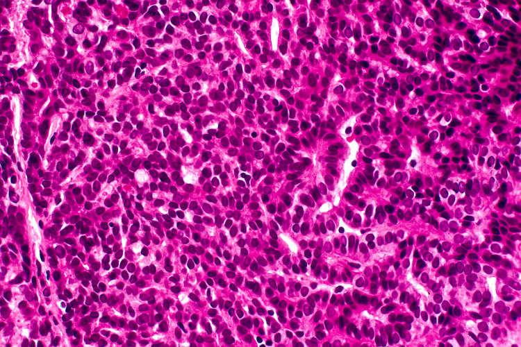 Basal cell adenoma Basal cell adenocarcinoma Mixed