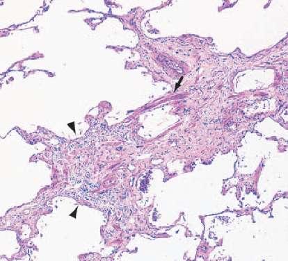 upper lobes of CHP (44%) than IPF (0%) Centrilobular fibrotic lesions more common