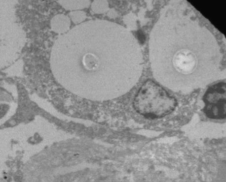 EM of arachnoid cell containing 2 cryptococcal cells with large capsules (mean 20/hpf).