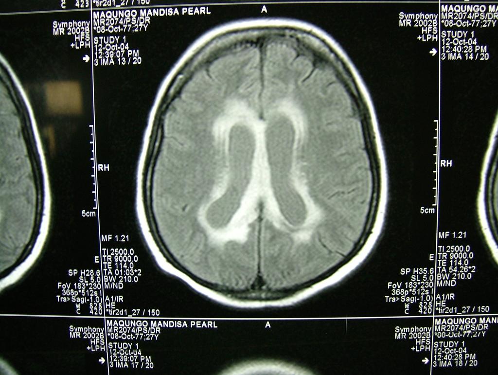 CRYPTOCOCCAL IRIS CASE: MRI