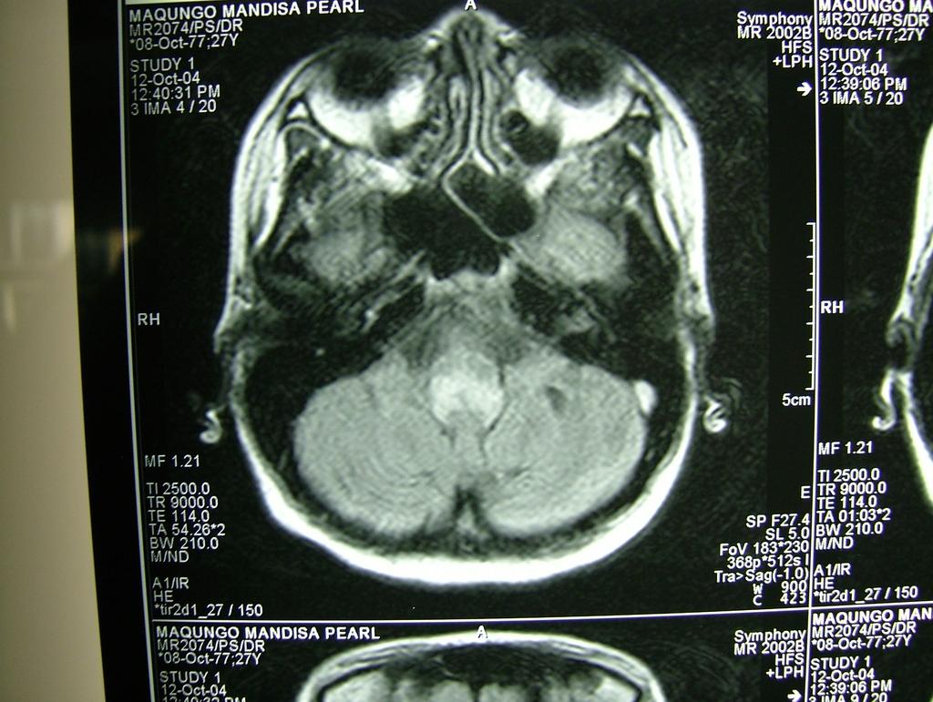and marked periventricular,