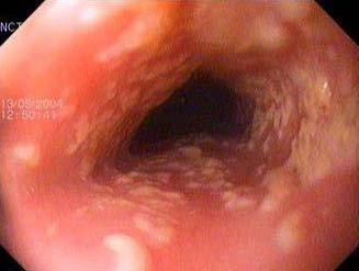 Esophageal  Oral ,