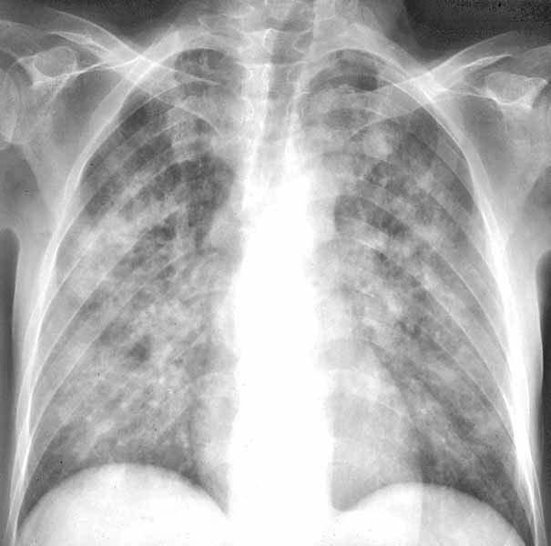 Pnuemocystis jirovecii Pneumonia Chest X-Ray