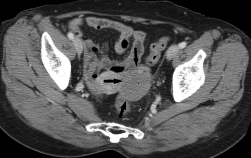 CT of Ovarian Metastasis A Fig. 1 57-year-old woman with bilateral ovarian metastasis from stomach cancer.