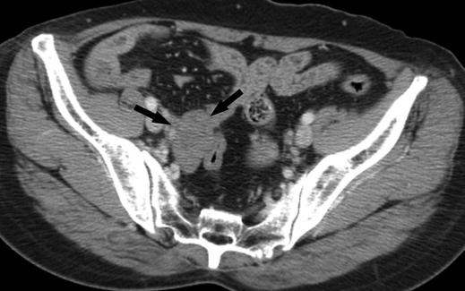 Misinterpretation of a metastatic ovarian tumor as a primary tumor may have adverse consequences for the patient, such as unnecessary surgery or inappropriate chemotherapy or radiation therapy.